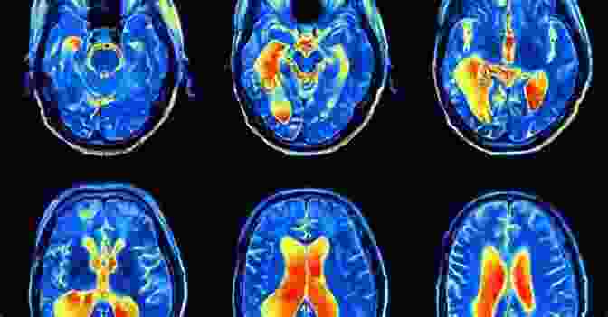 A Brain Scan Showing Different Brain Regions Activated During A Task To Neuroimaging Analysis (Oxford Neuroimaging Primers)